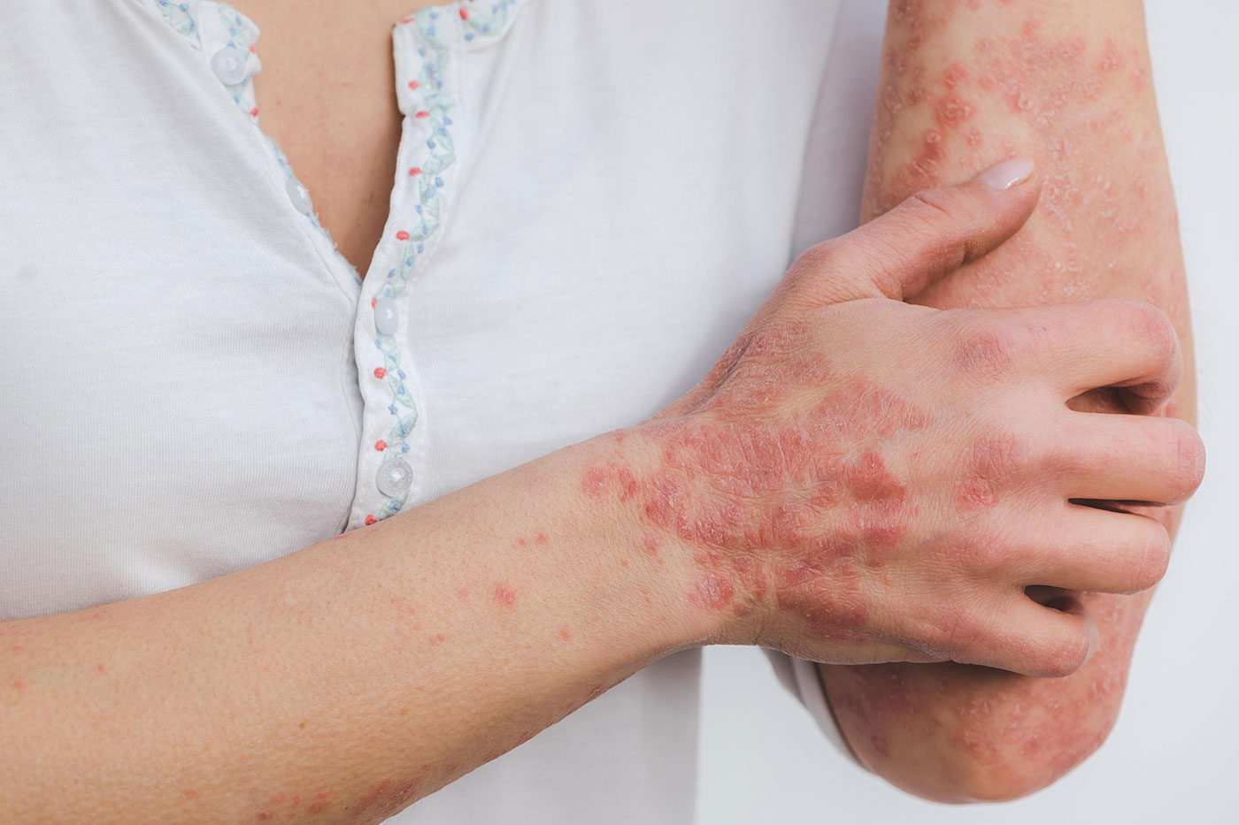 Psoriasis: Studie legt Grundstein für neue Behandlungsstrategie
